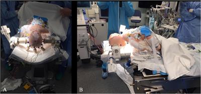 The impact of 1.5-T intraoperative magnetic resonance imaging in pediatric tumor surgery: Safety, utility, and challenges